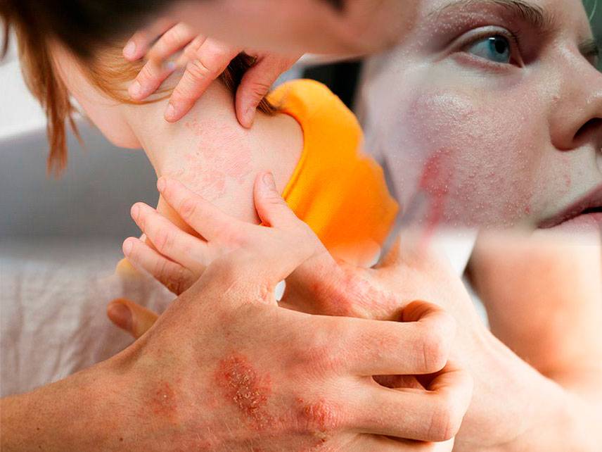 Qué es la dermatitis de contacto: síntomas, diagnóstico y tratamiento.