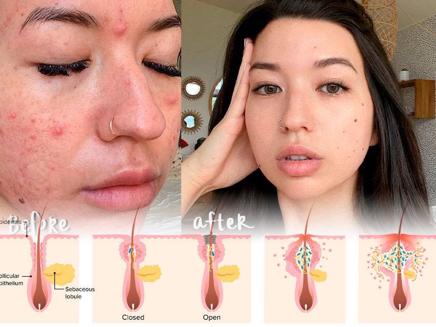La guía completa del acné vulgar: Lo que debe saber