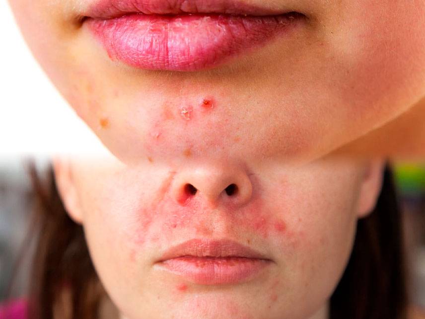 What triggers perioral dermatitis - symptoms, diagnosis and treatment