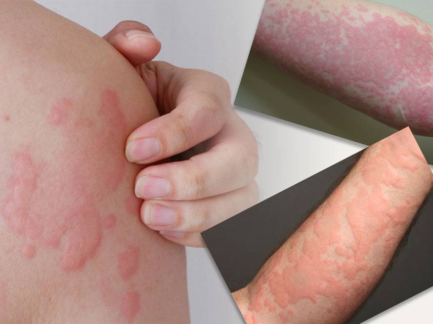 Is urticaria a serious disease? Signs, causes and risk factors