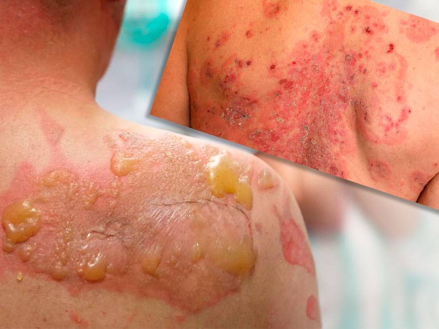 What are the signs and symptoms of pemphigus?